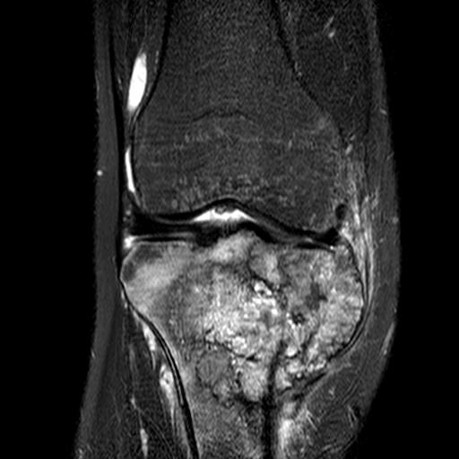 Osteosarcoma Proximal Tibial MRI0001